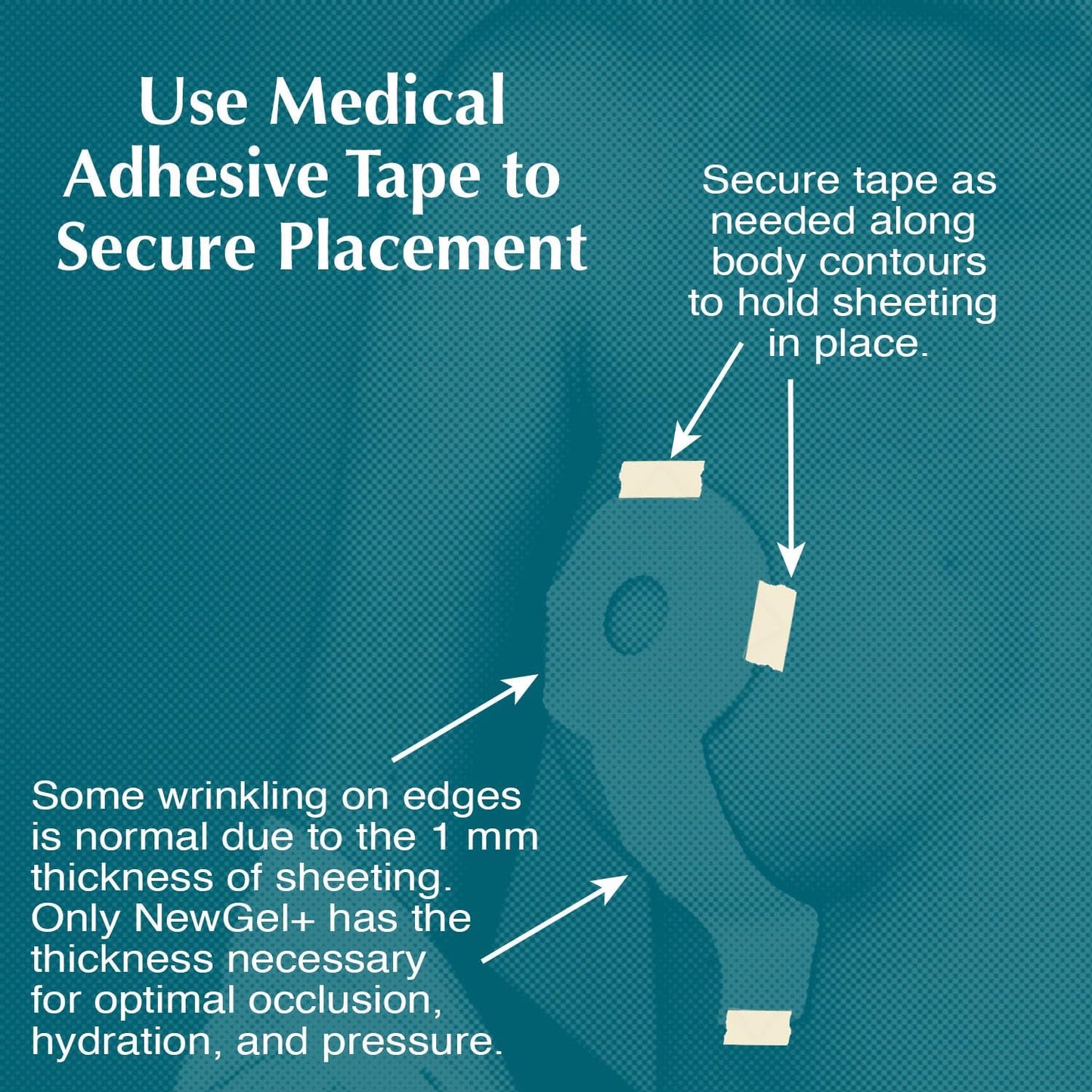 NewGel+ Advanced Silicone Scar Treatment Tape Lollypop Shaped, 1 mm thick for Post Breast Surgery Cosmetic Procedure, 2.875" x 6.5", 2-Count - Beige