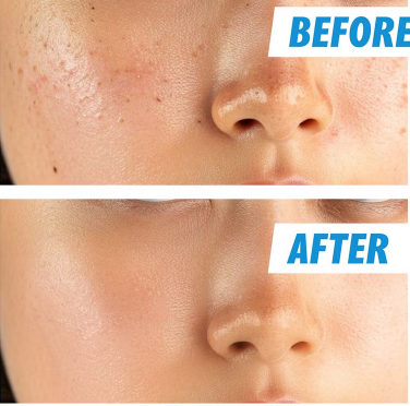 Nightingale Ecto Hyaluronic Soothing Face Sheet Mask For All Skin Types 27ml, Pack of 1’s Nightingale