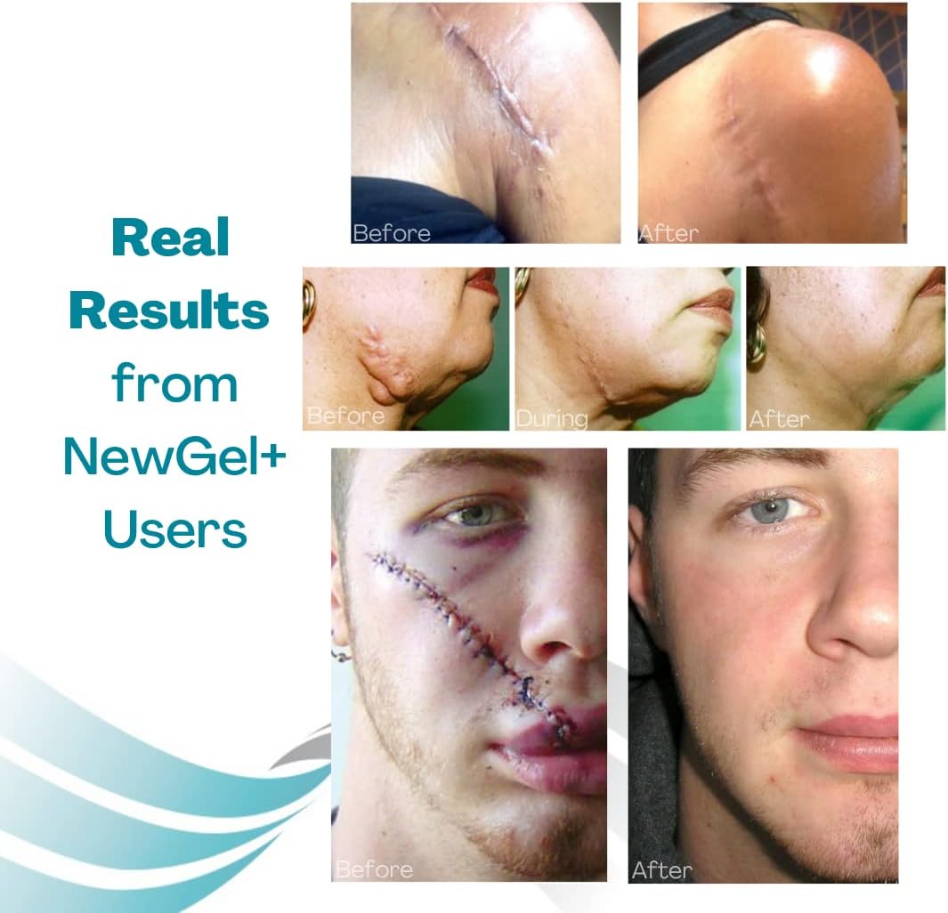 NewGel+ Advanced Silicone Scar Treatment Tape Lollypop Shaped, 1 mm thick for Post Breast Surgery Cosmetic Procedure, 2.875" x 6.5", 2-Count - Beige