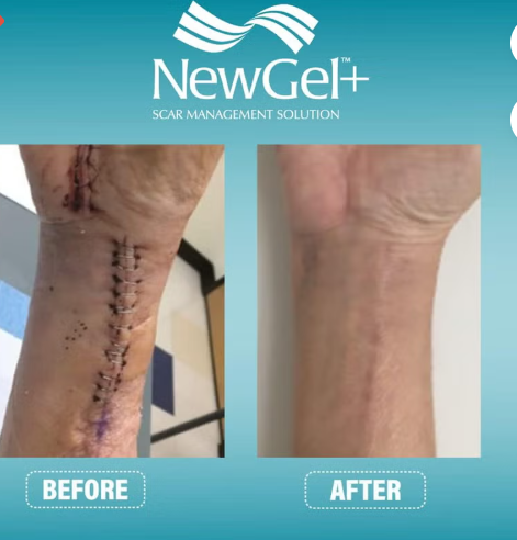 NewGel+ 24" x 2" Abdomen/Extremity Silicone Strip, Clear NG-364, Pack of 1's